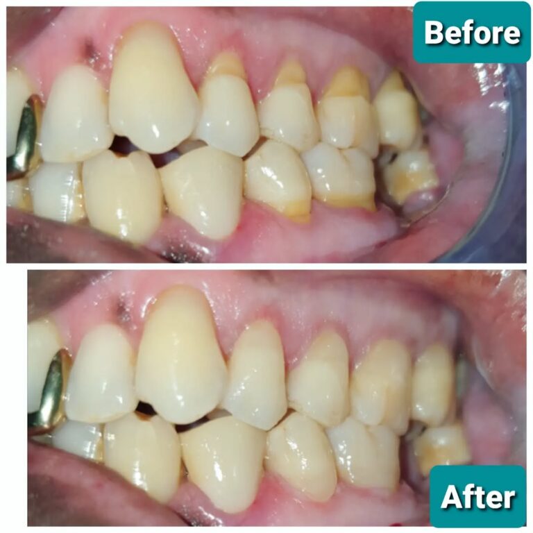 Cervical Toothbrush Abrasions...... as result of forceful tooth brushing, vigirous techniques a.webp