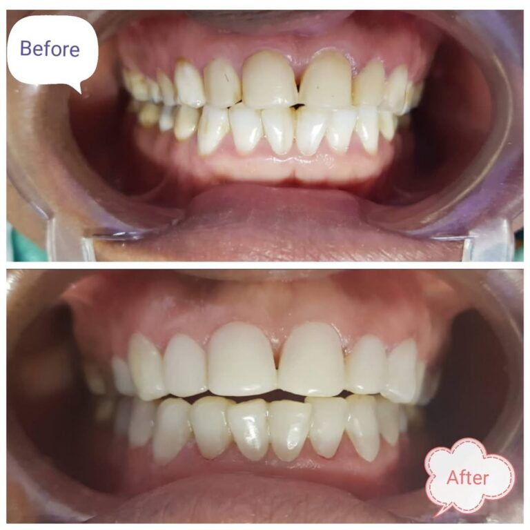 Dnt let yellow teeth dent ur self confidence....Smile Dr is here for u🤩😷🧐