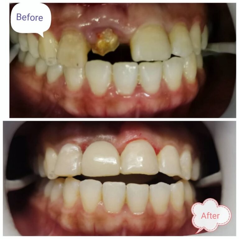 Don't let a missing tooth ruin ur smile😁.... stuckbond bridge, same day results, cost effective