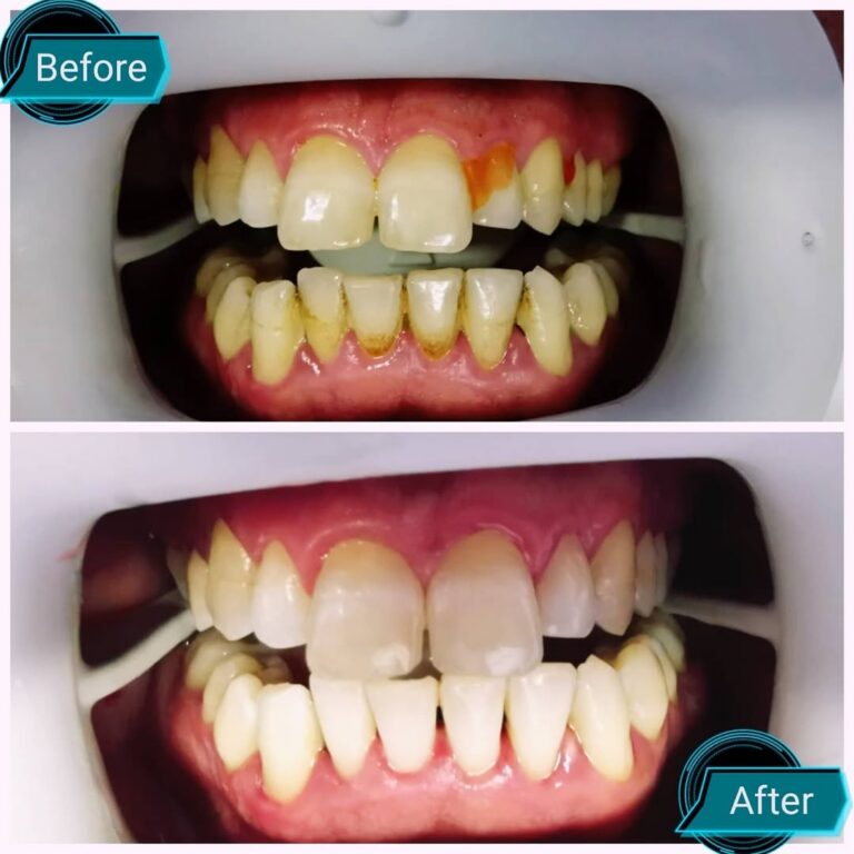 Remember to see ur dentist for the 6minths check up and cleaning.....🪥🪥🪥